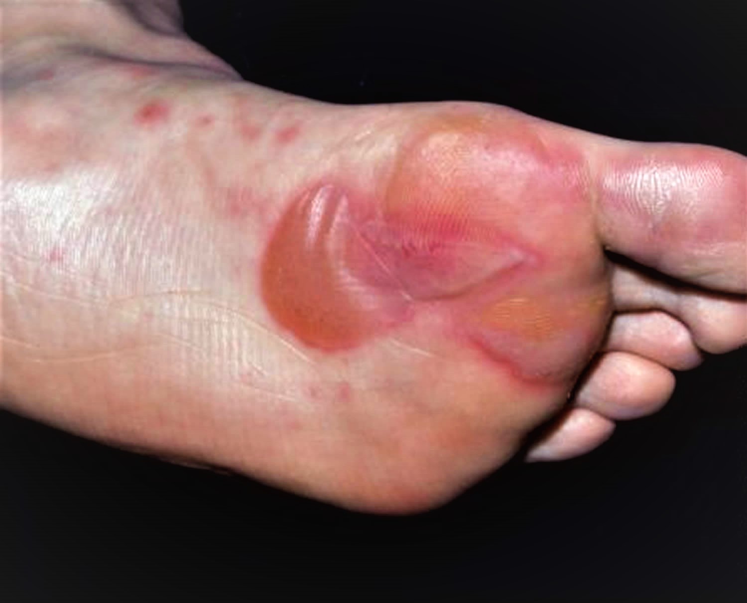 red-rash-on-bottom-of-feet-pictures-photos