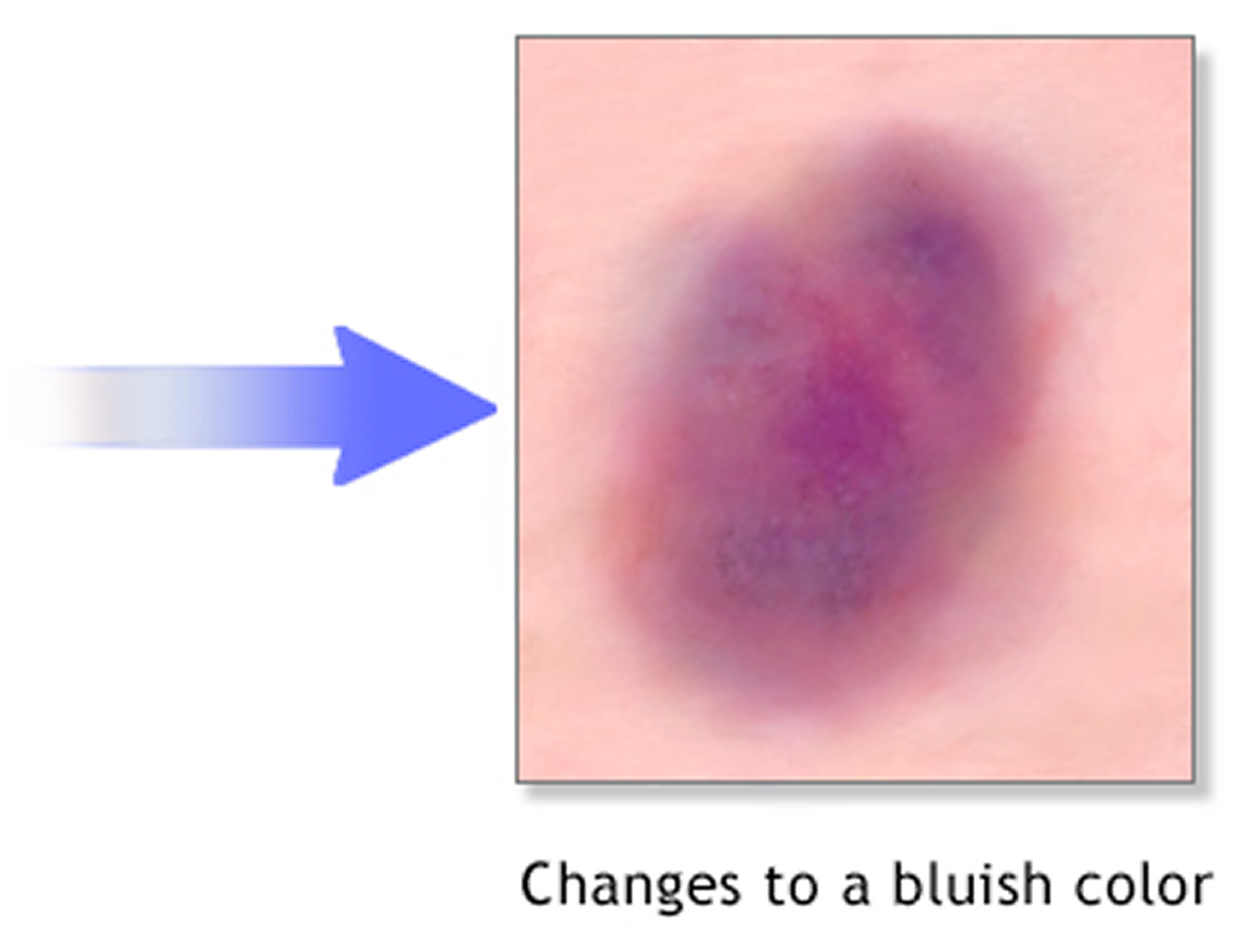 bruise - causes, diagnosis, treatment, home remedy and healing time