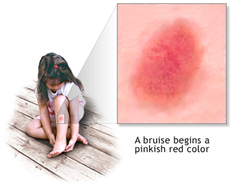 Bruise Causes, Diagnosis, Treatment, Home Remedy and Healing Time