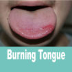 burning-tongue