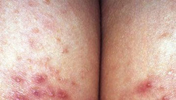 butt pimples