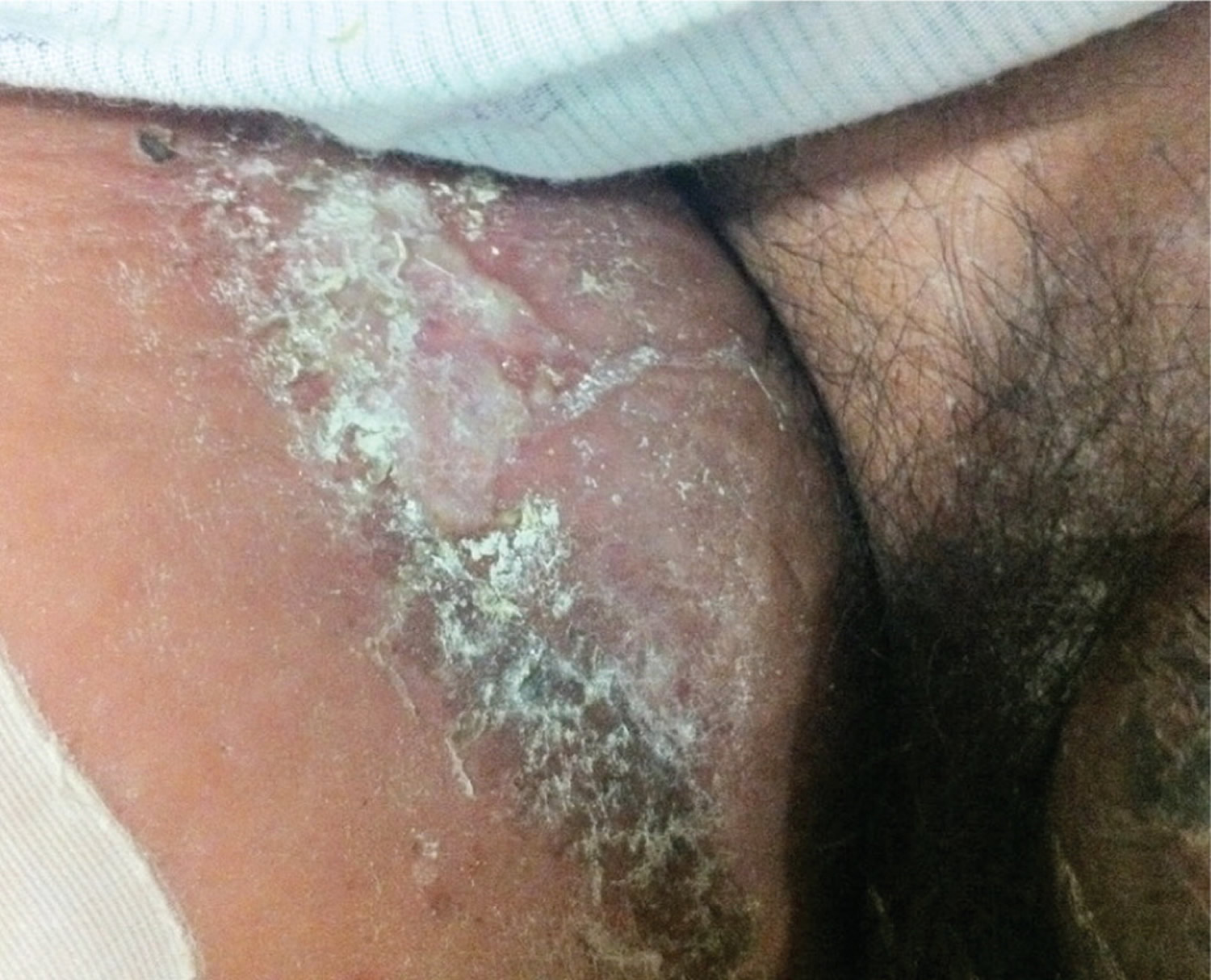 candida infection of inner thigh