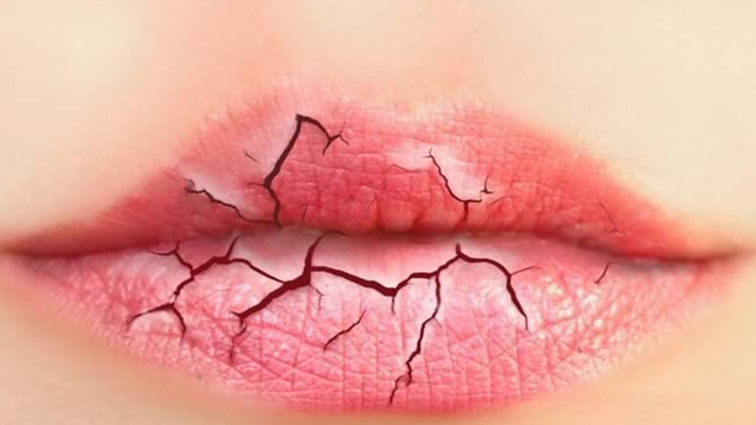 How To Get Rid of Chapped Lips