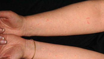 cholinergic urticaria