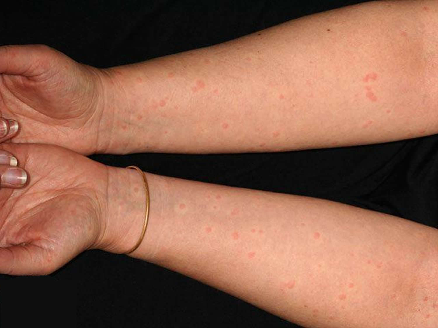 cholinergic-urticaria-causes-diagnosis-treatment-and-prevention