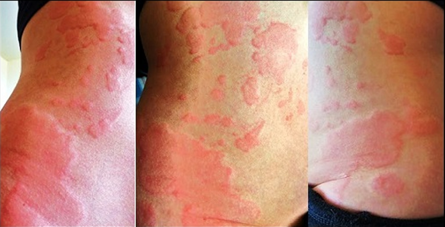 urticaria pictures