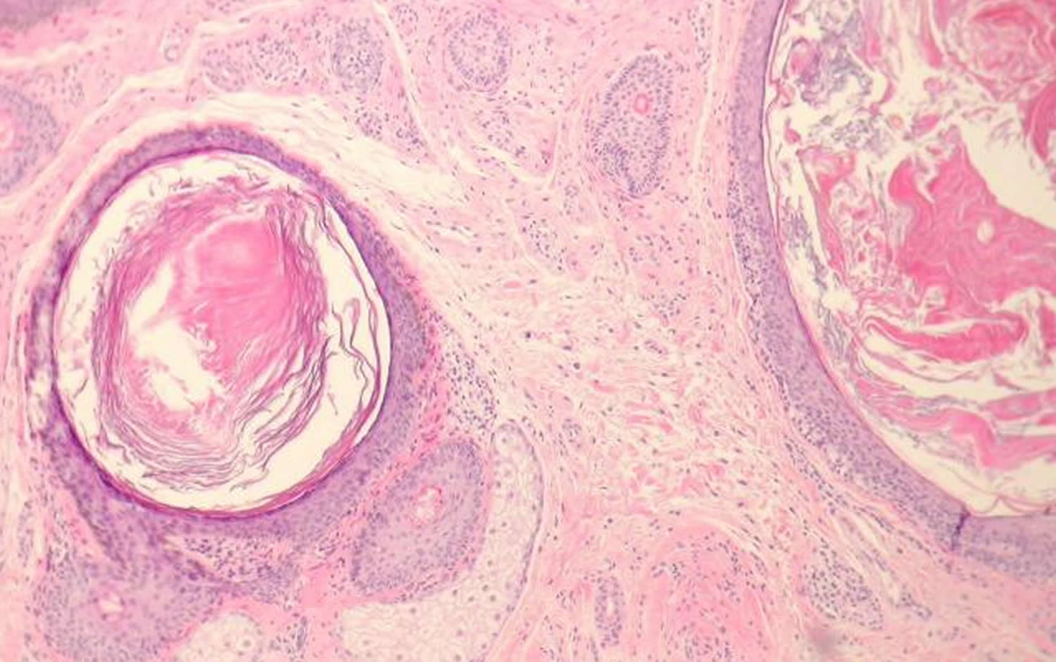 clogged pores histology