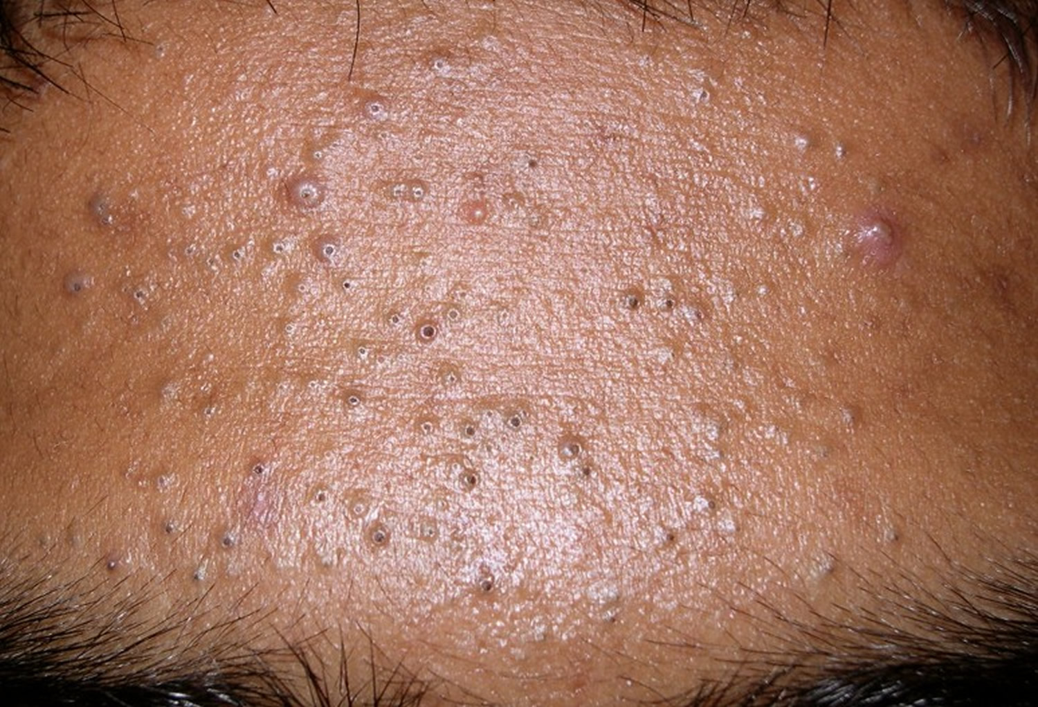 Rash With Red Bumps With Whiteheads