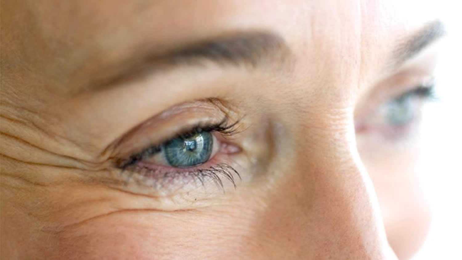 Crows Feet - Causes of Crows Feet and Wrinkles - Treatment Options