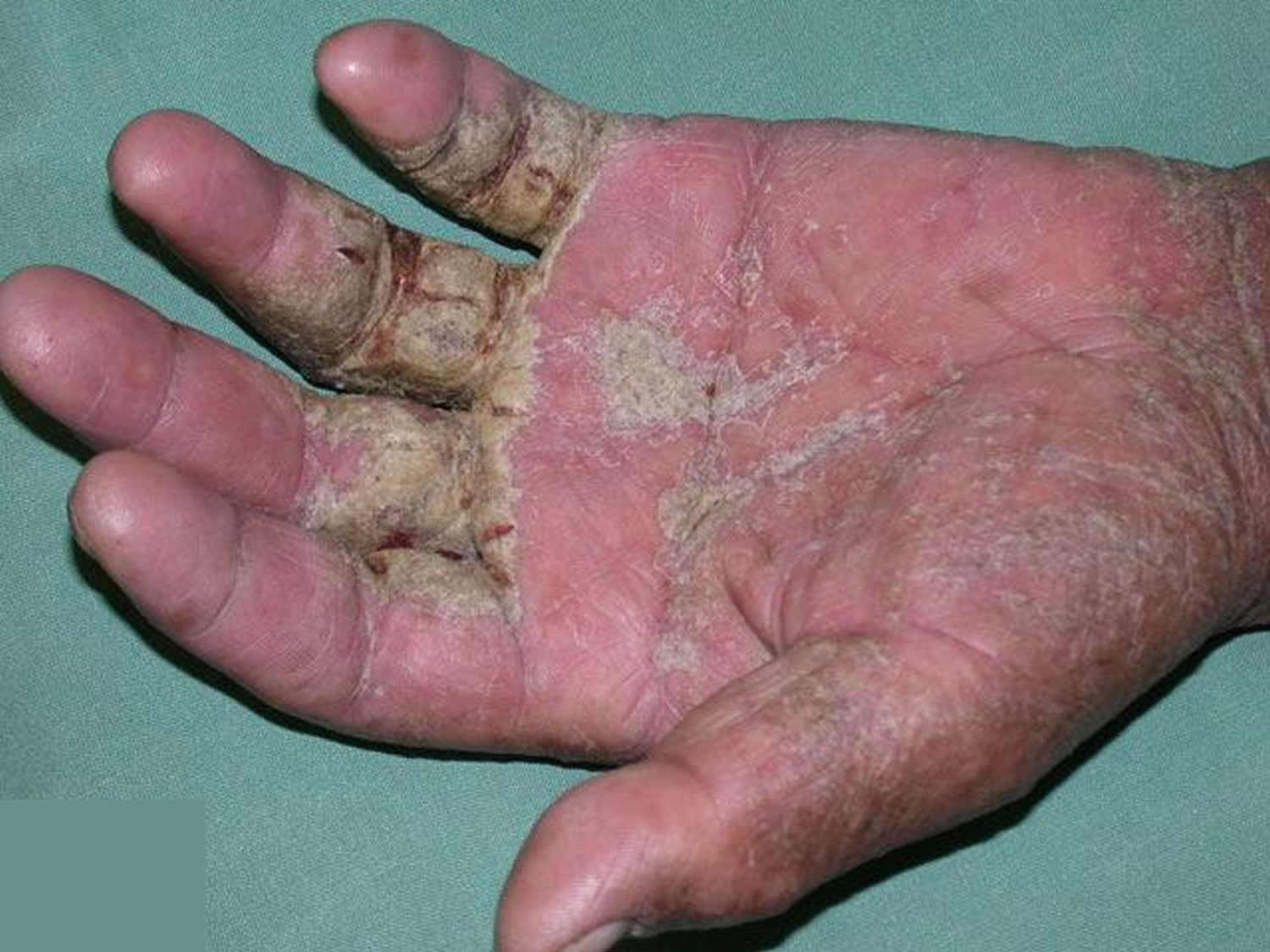 crusted scabies