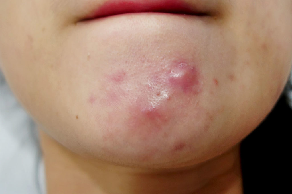 Why Am I Getting Cystic Acne On One Side Of My Face - Printable ...