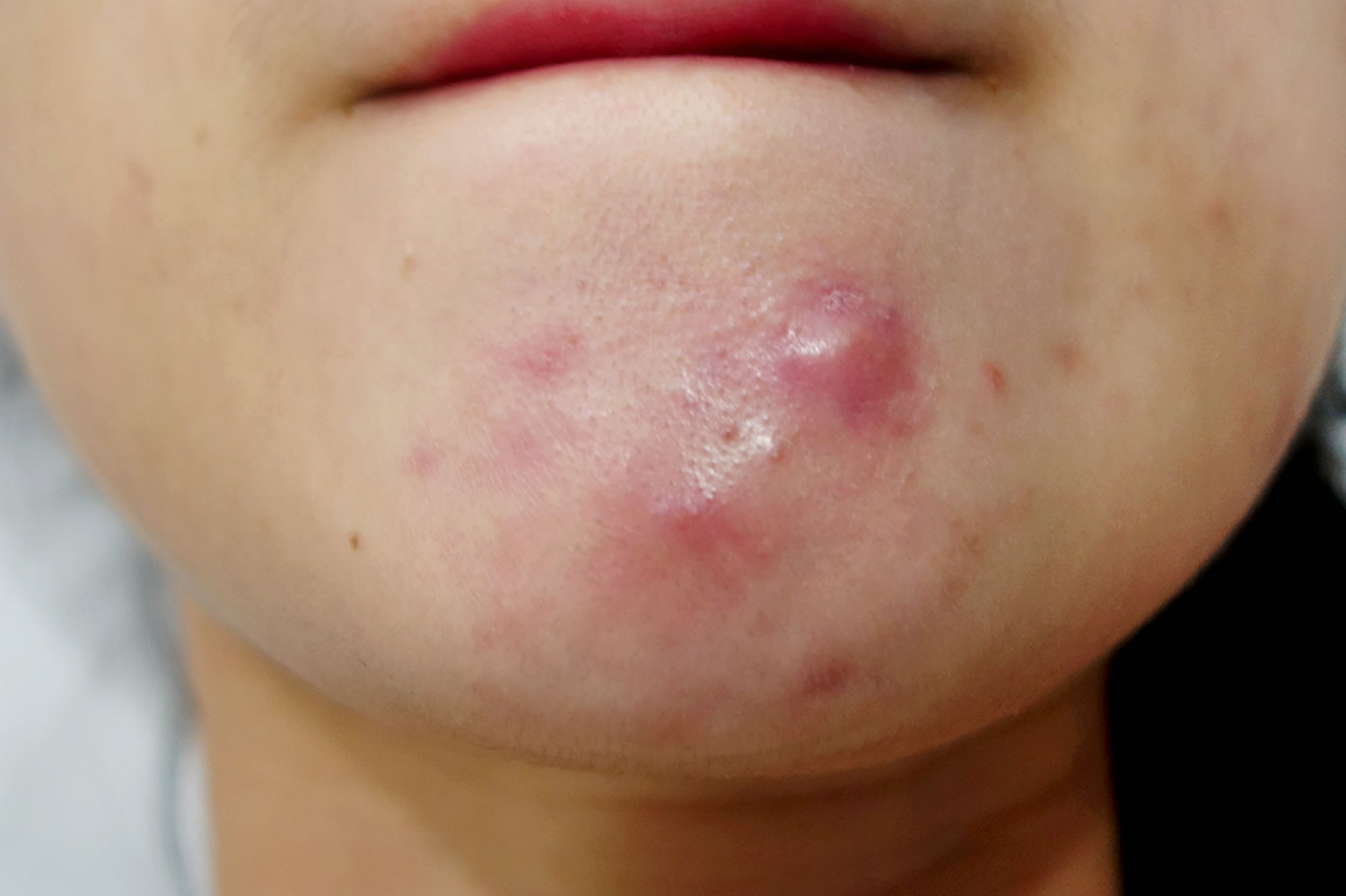 mild-nodulocystic-acne