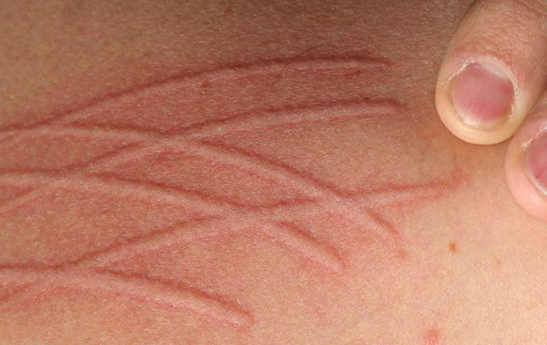 Dermatographic Urticaria Causes Symptoms Treatment And Prevention