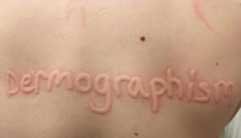 dermatographic urticaria symptoms