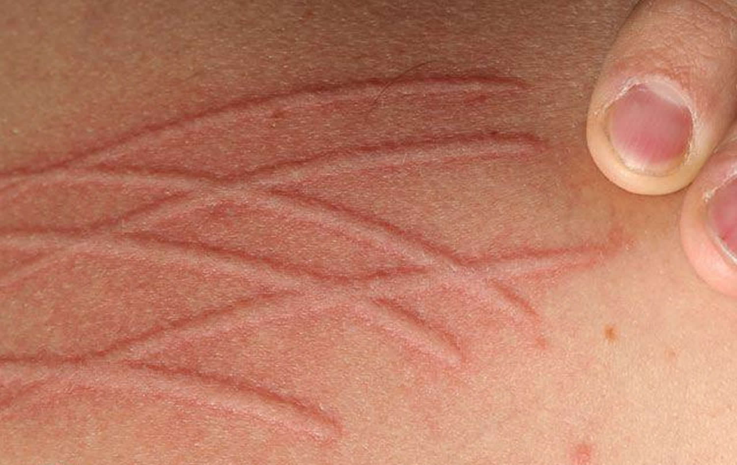 dermatographic urticaria