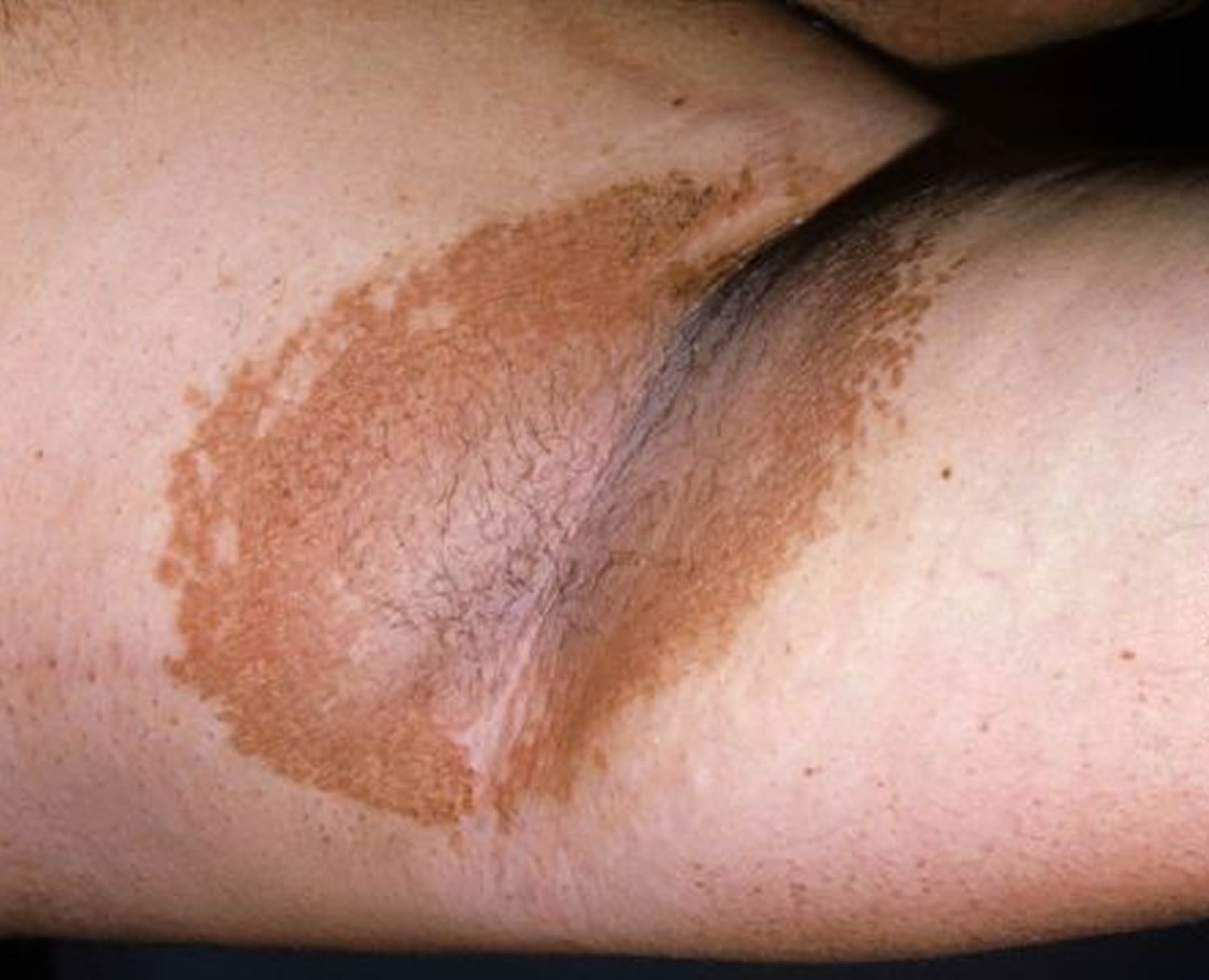 Dark Inner Thighs - Causes, Diagnosis, Treatment, and Prevention