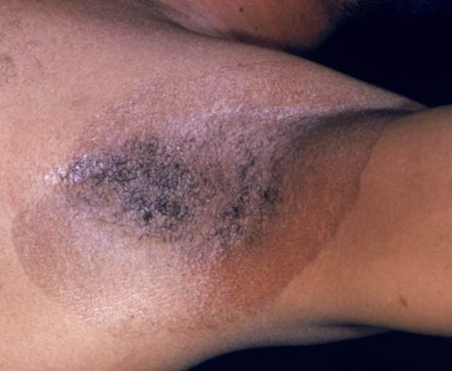 acanthosis nigricans inner thighs