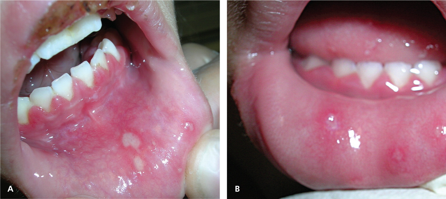 mouth-ulcers-herpes-simplex-pictures-management-and-treatment-of