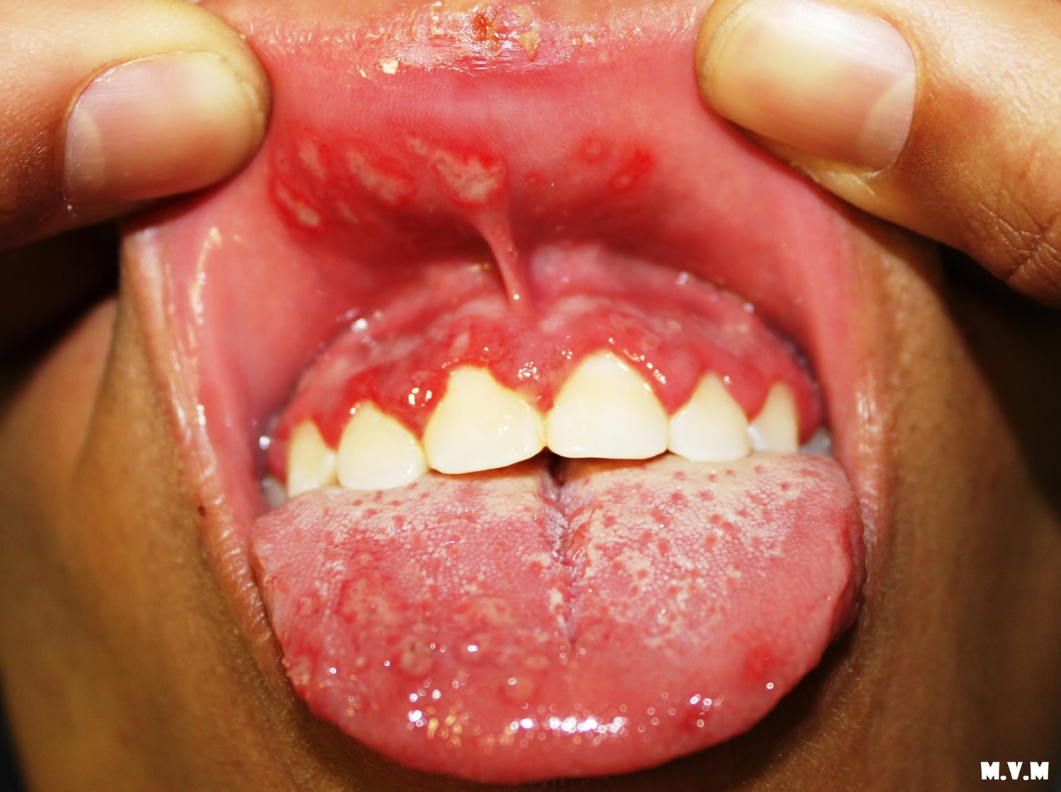 Blisters On Tongue Blisters Under Or Side Of Tongue Causes Treatment