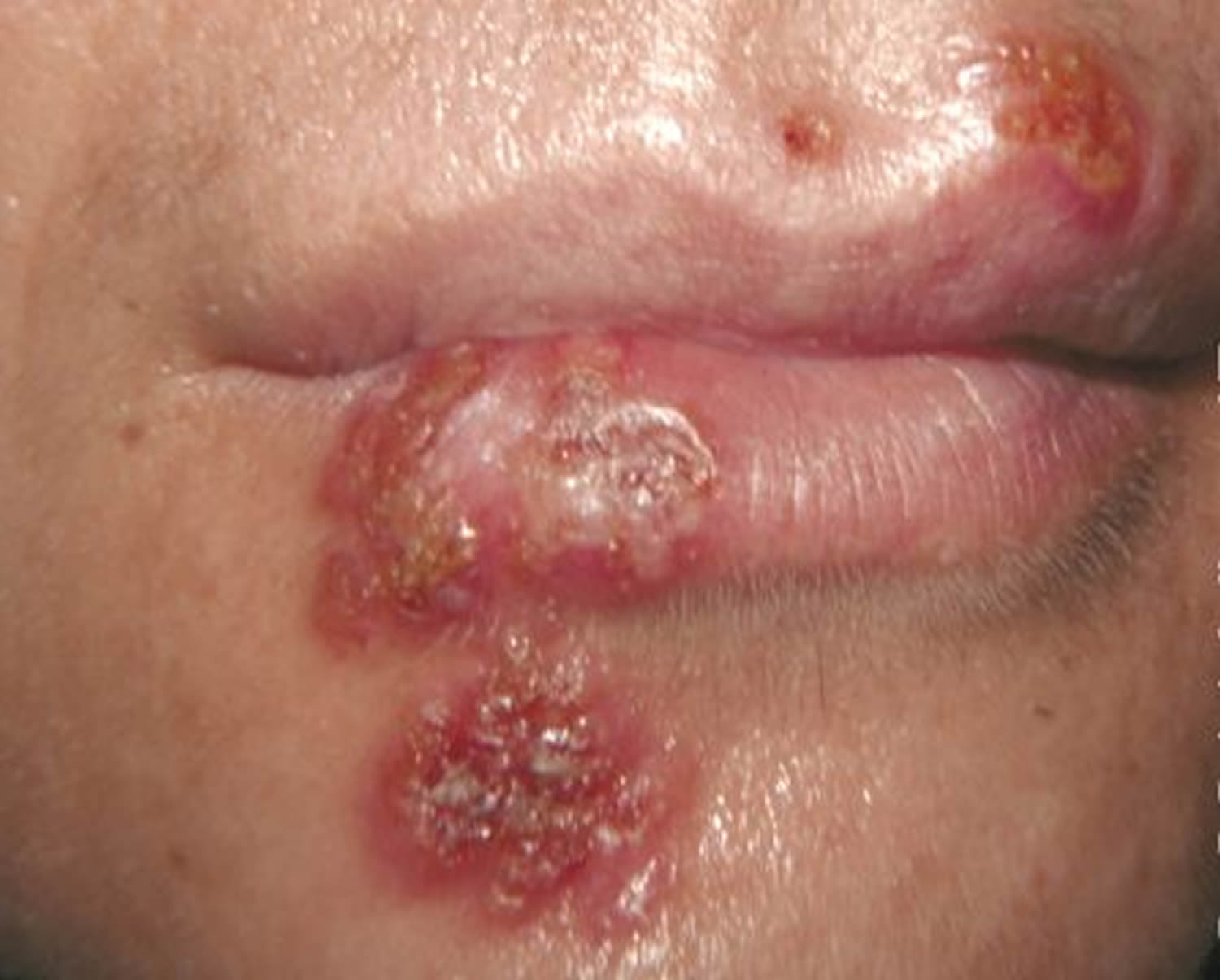 fever blisters - cold sores - lips