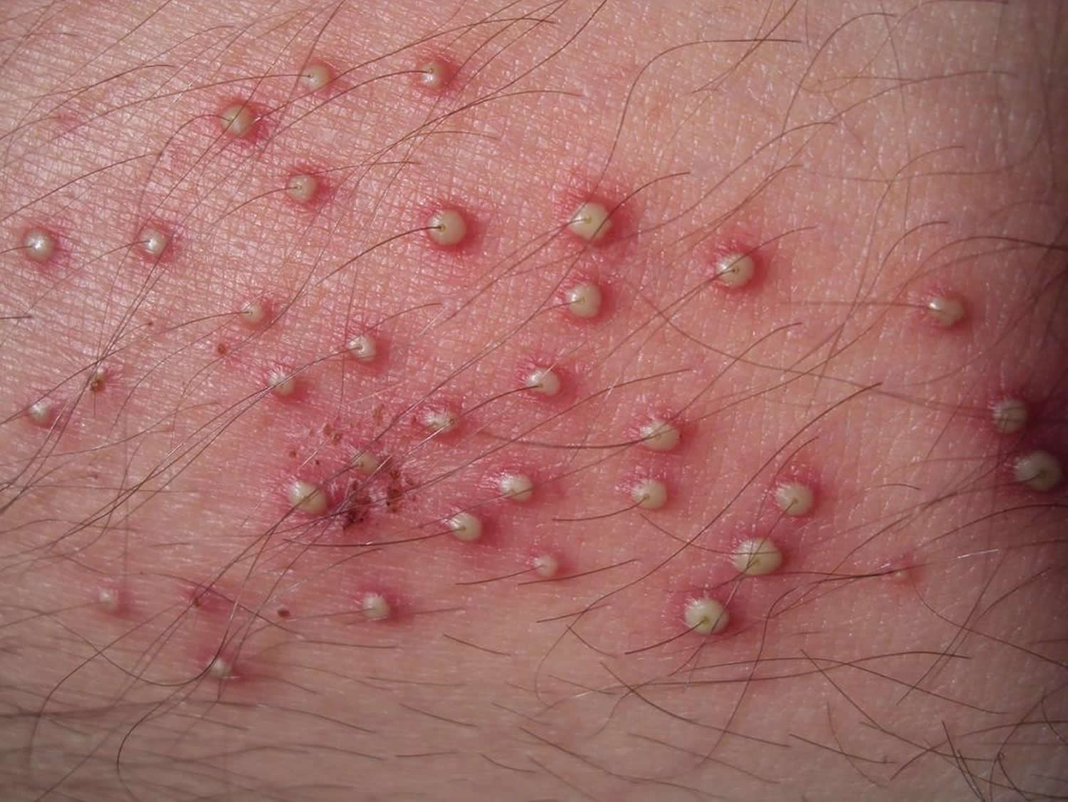 folliculitis