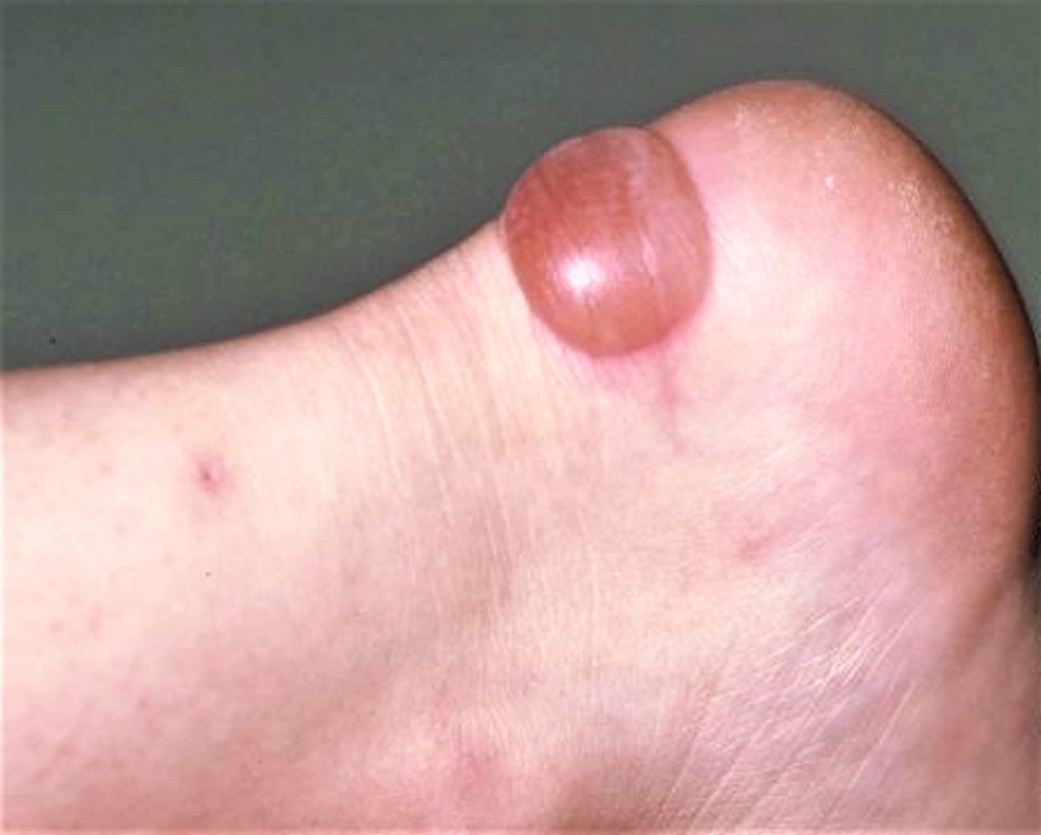 big-toe-blisters-types-causes-prevention-toe-blister-blisters