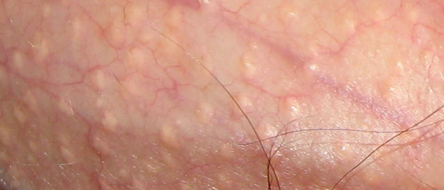 Fordyce Spots On Head Of Penis 85