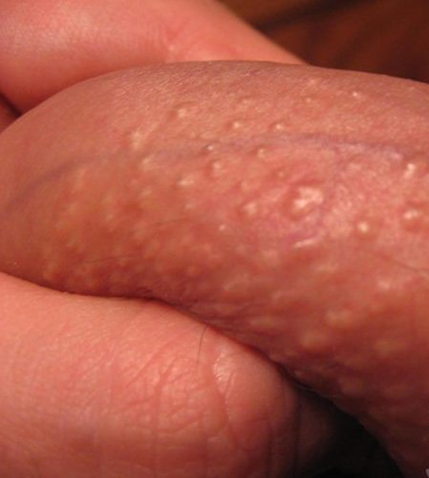fordyce spots penis