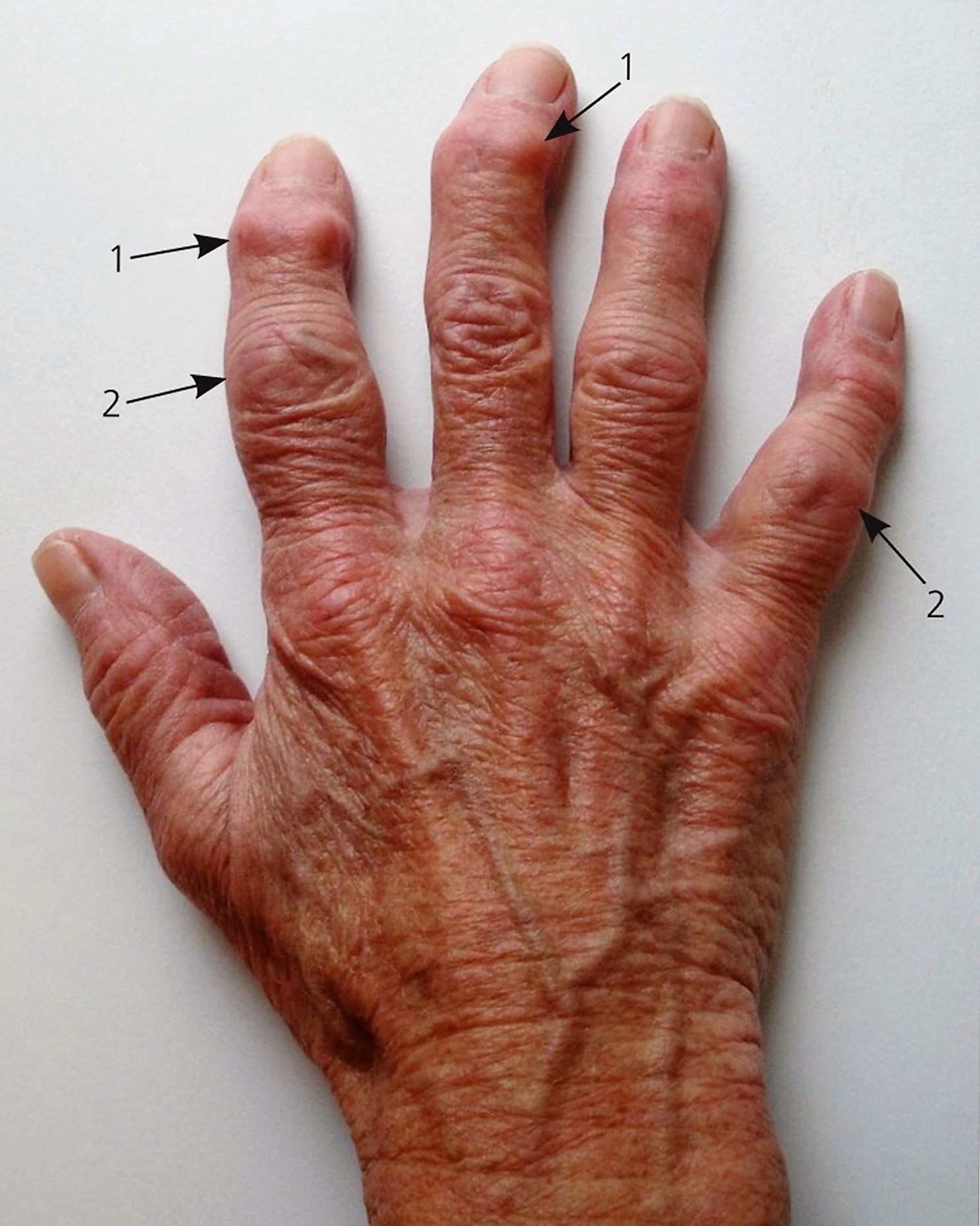 arthritis on hand fingers        <h3 class=