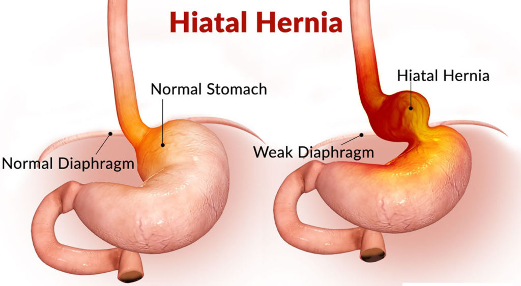 what is a hiatal hernia