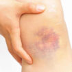 how to heal a bruise