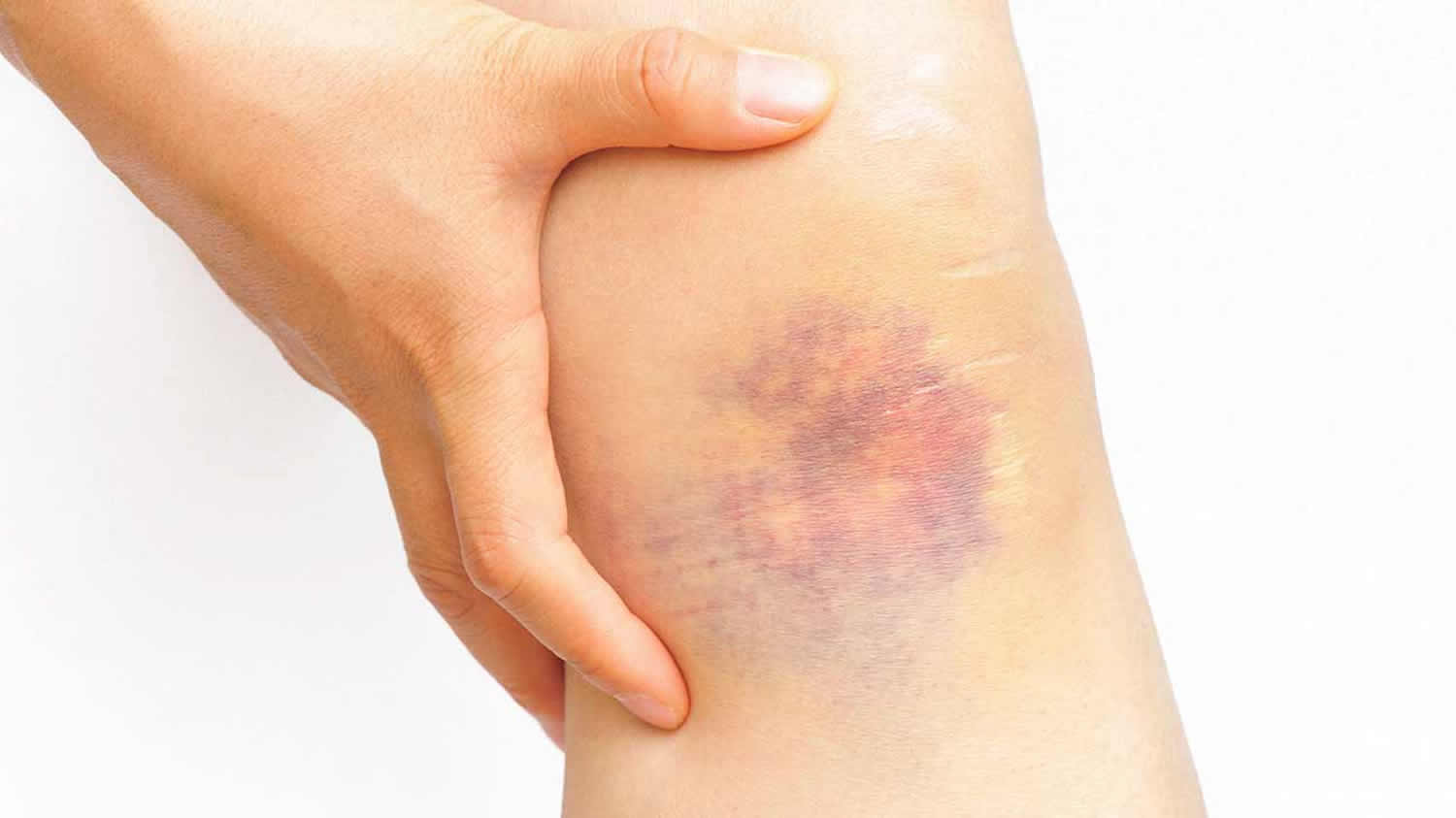 How Long Will A Bad Bruise Take To Heal