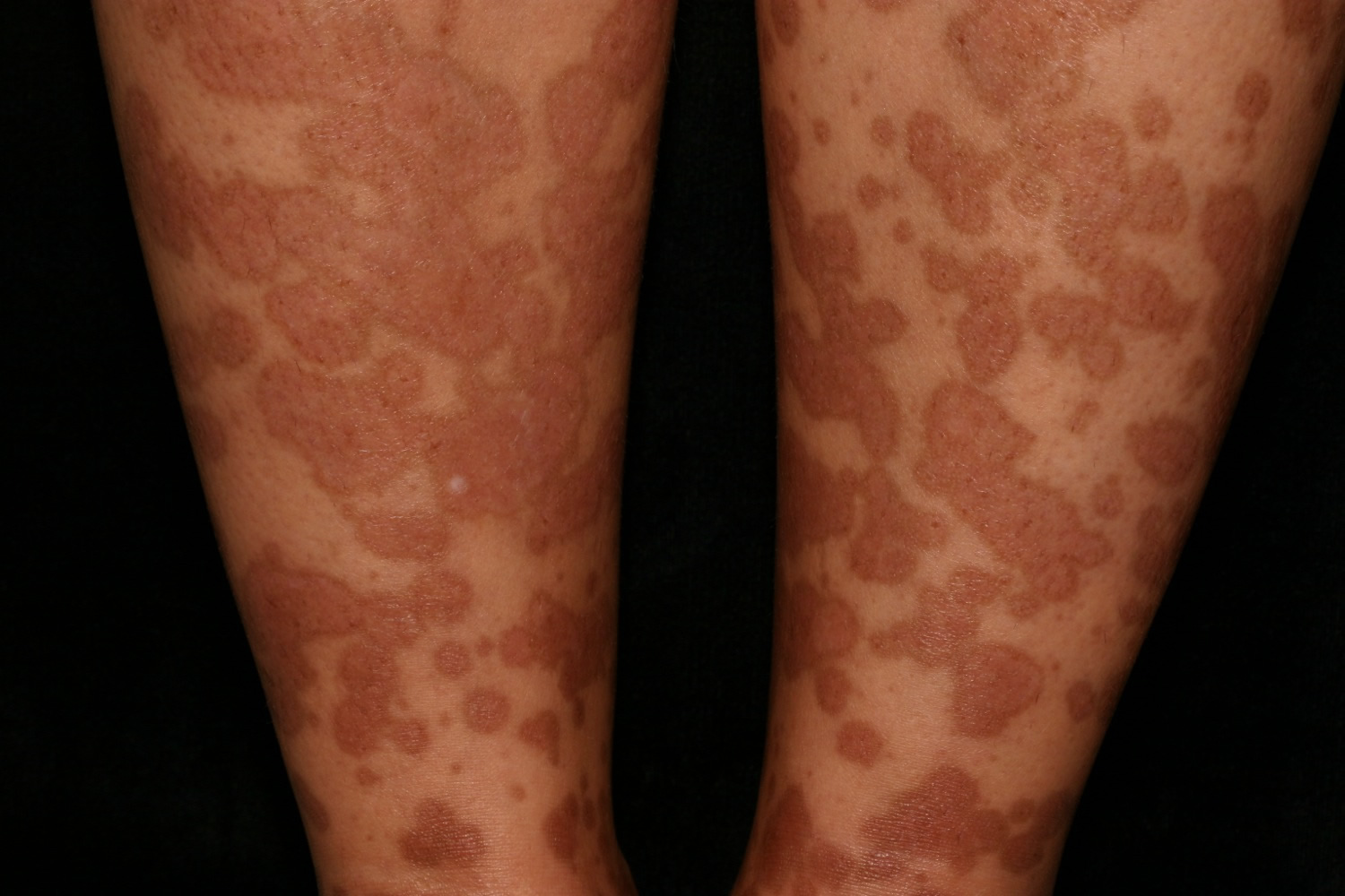 hypopigmentation leg