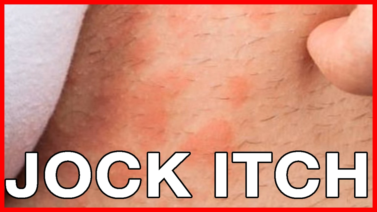 How to Cure Jock Itch Causes of Jock Itch and Remedies 