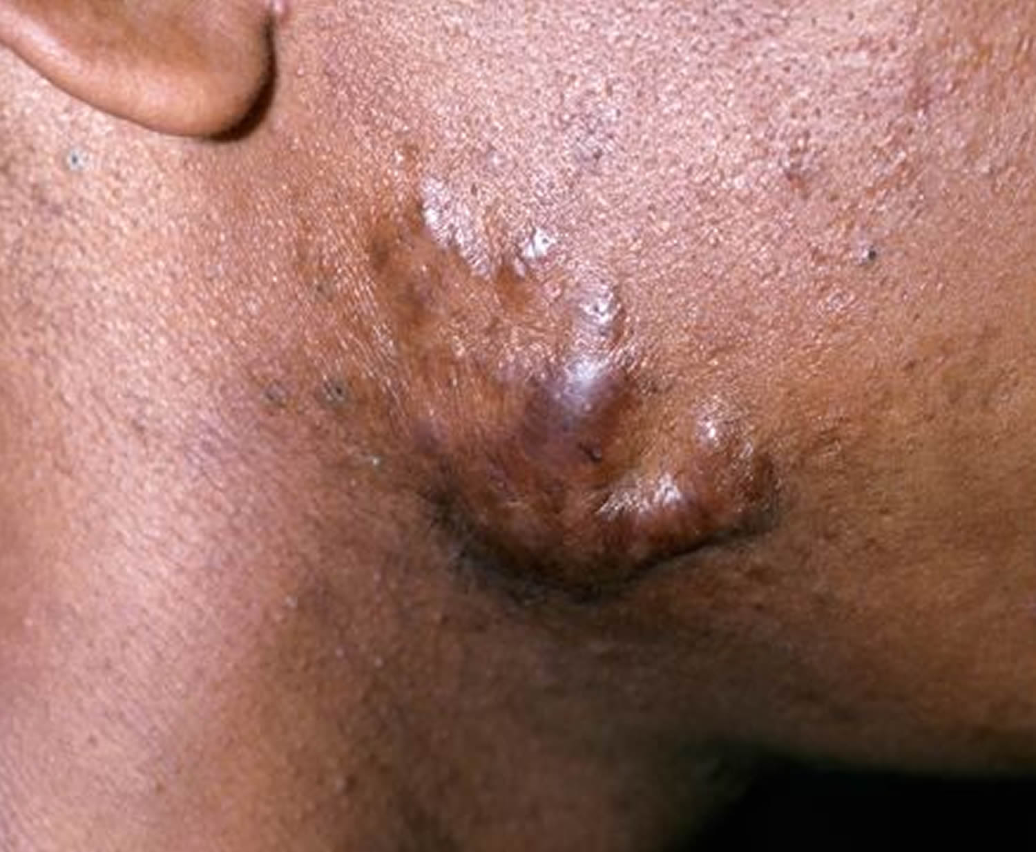 keloid_after acne