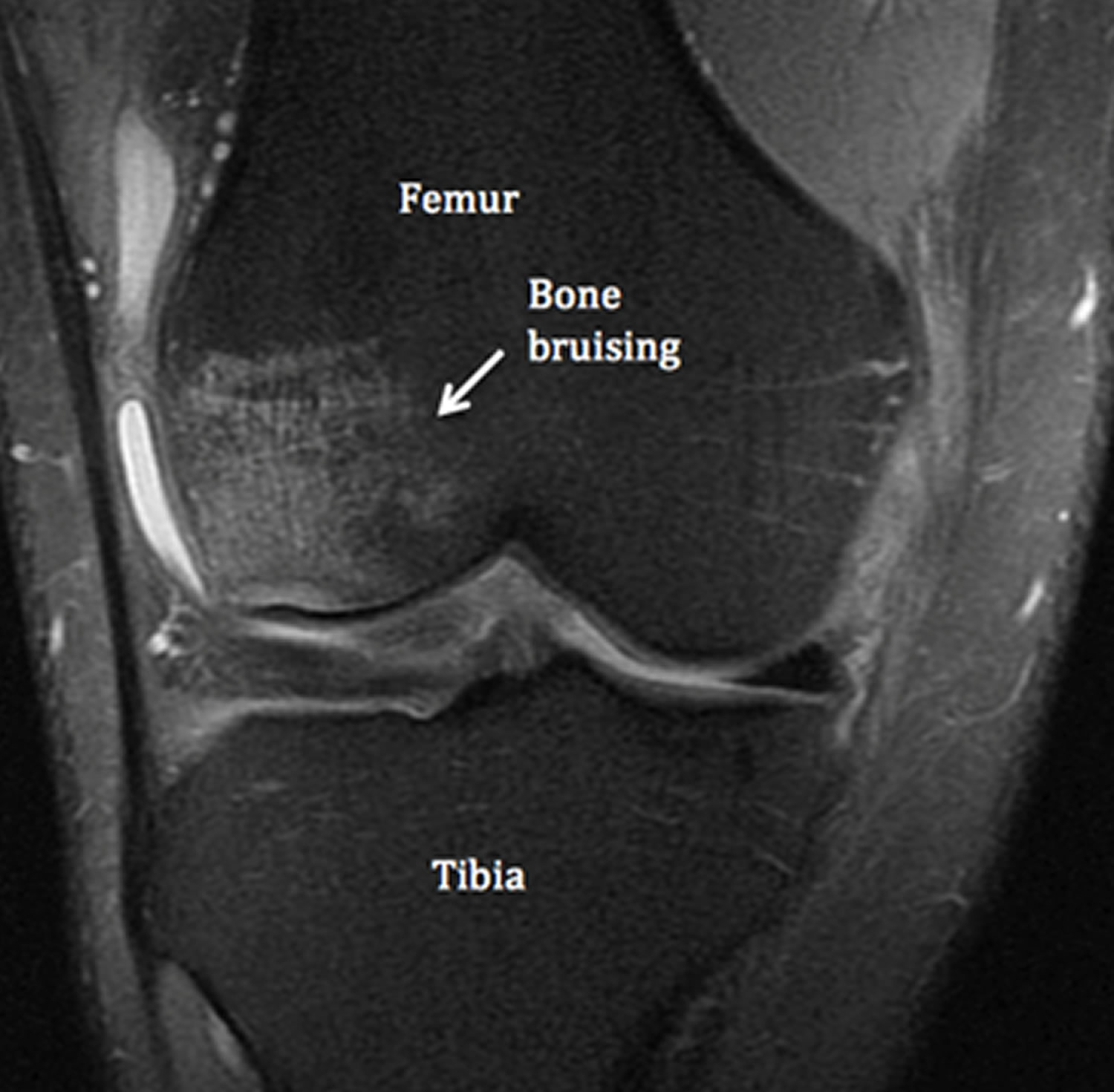 knee bone bruise