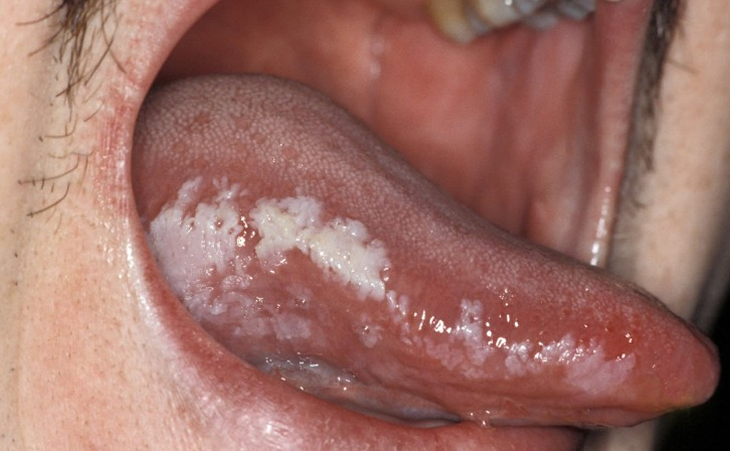 leukoplakia on tongue