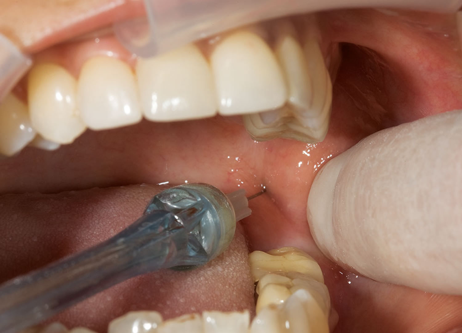 mandibular nerve block