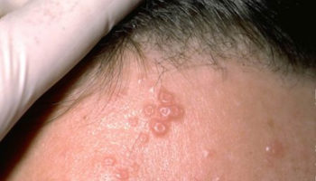 molluscum contagiosum