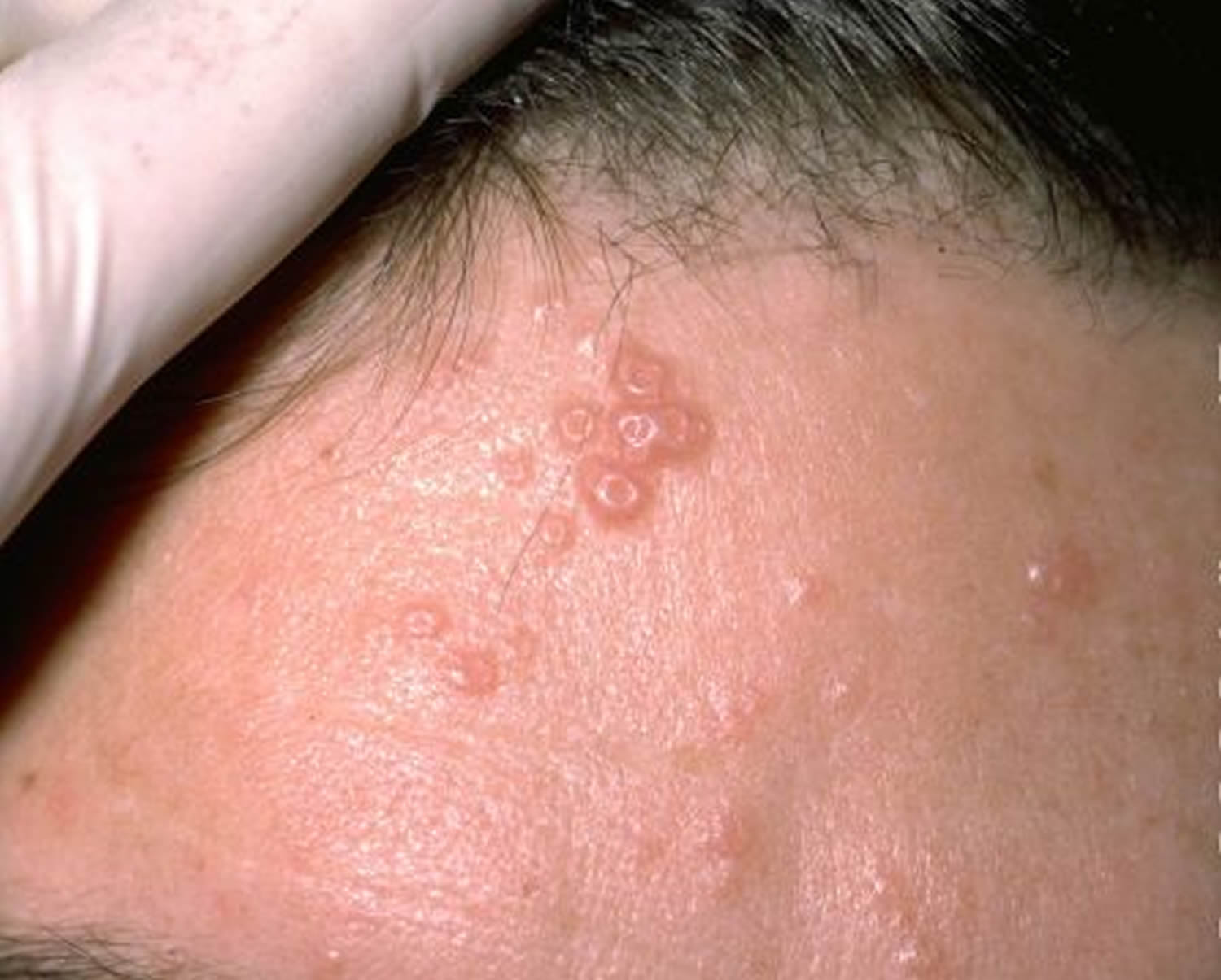 Molluscum Contagiosum Causes Symptoms Transmissions R