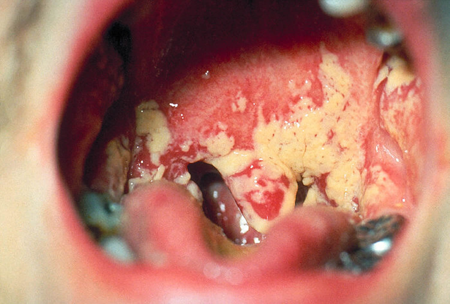 oral thrush