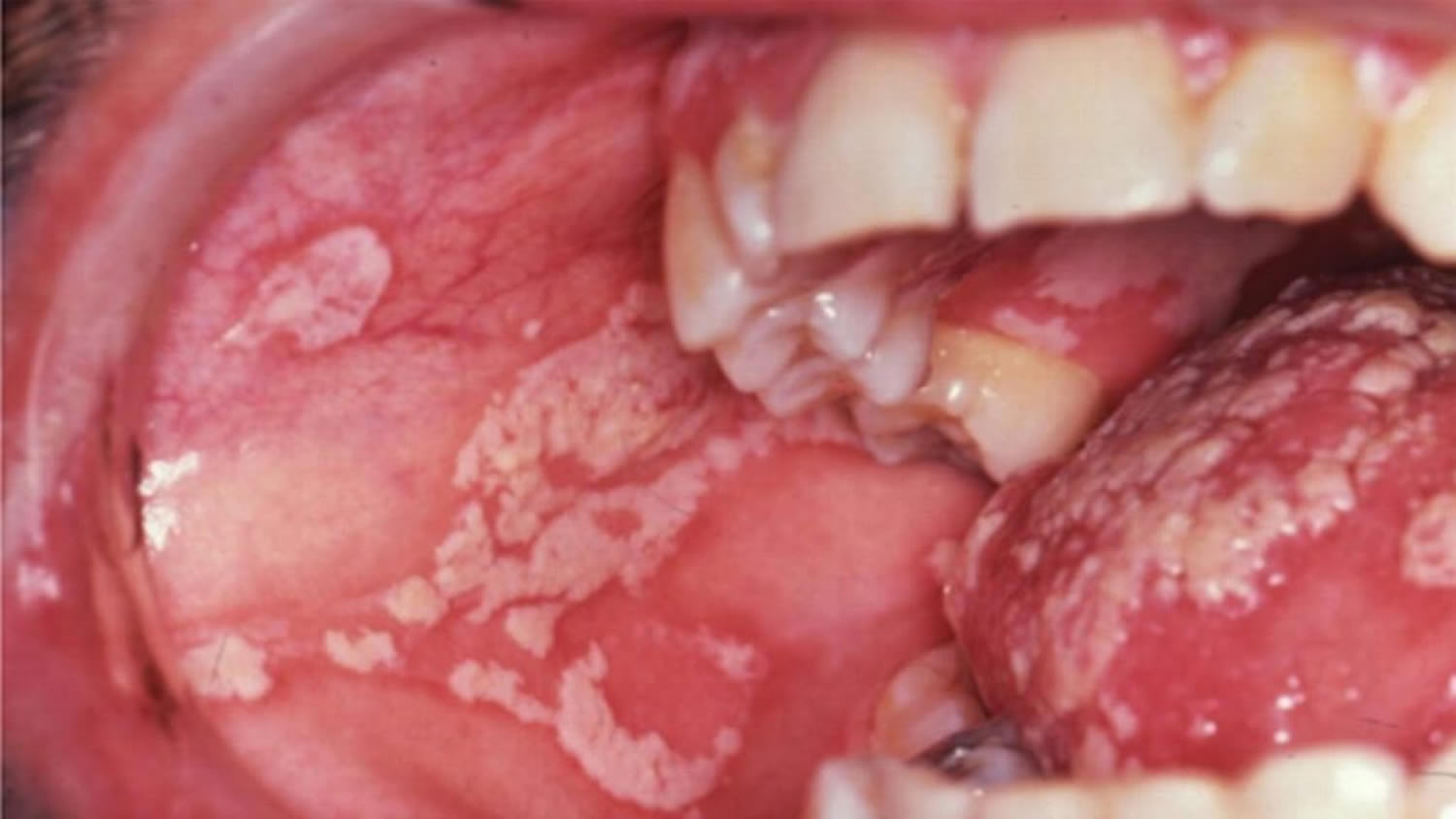 thrush in adults mouth