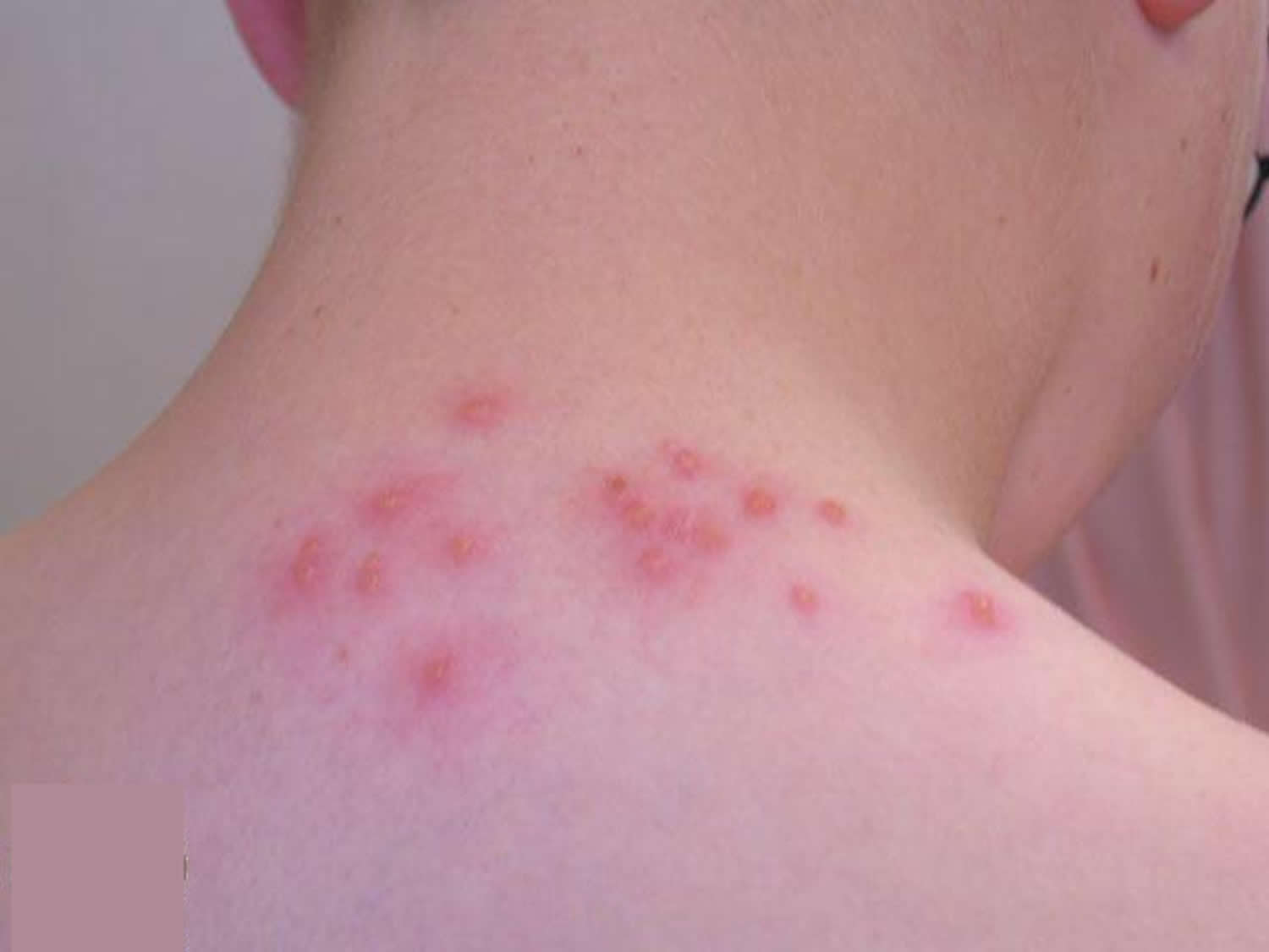 papular urticaria