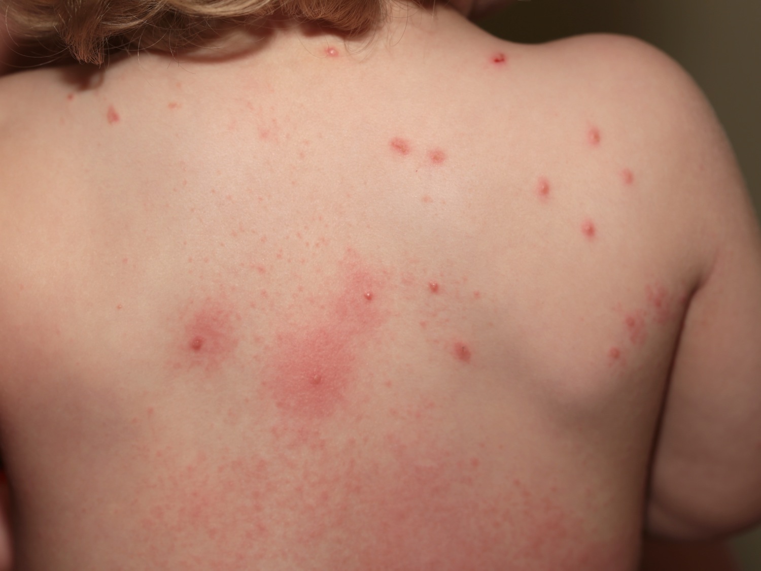 papular-urticaria-causes-symptoms-diagnosis-treatment-prevention