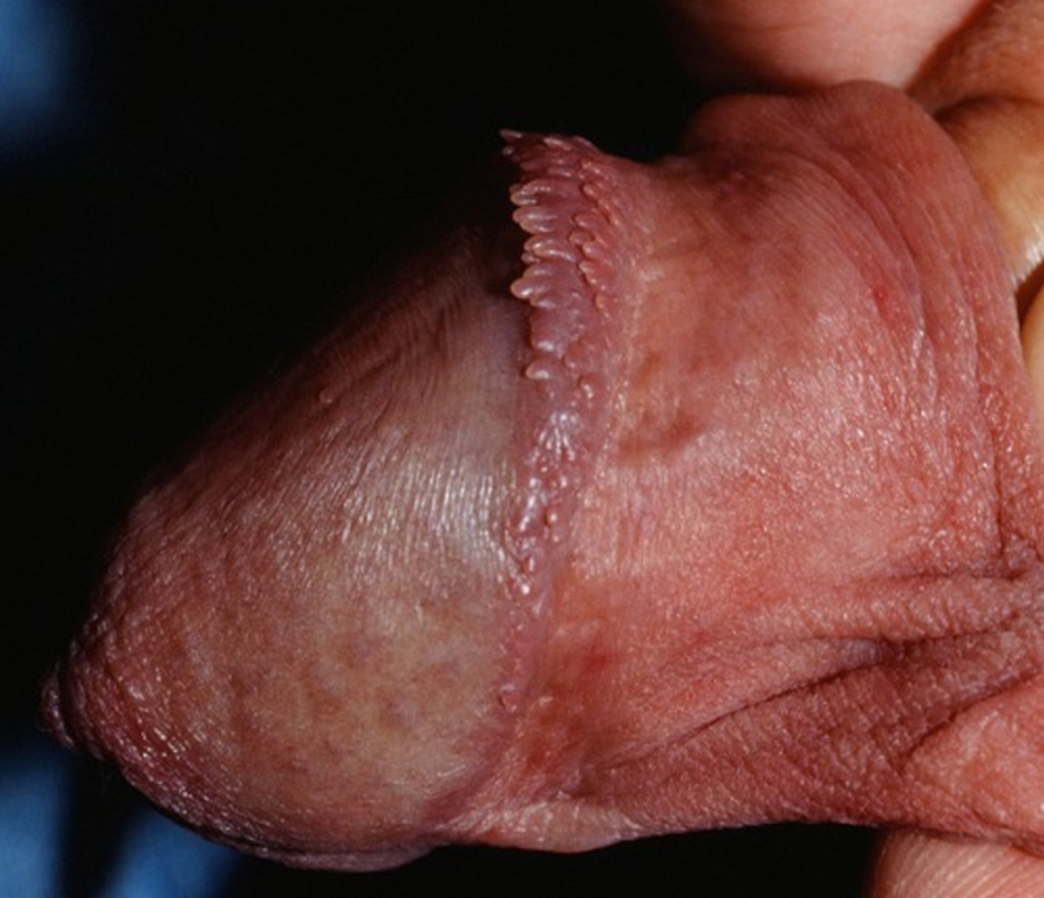 pearly penile papules