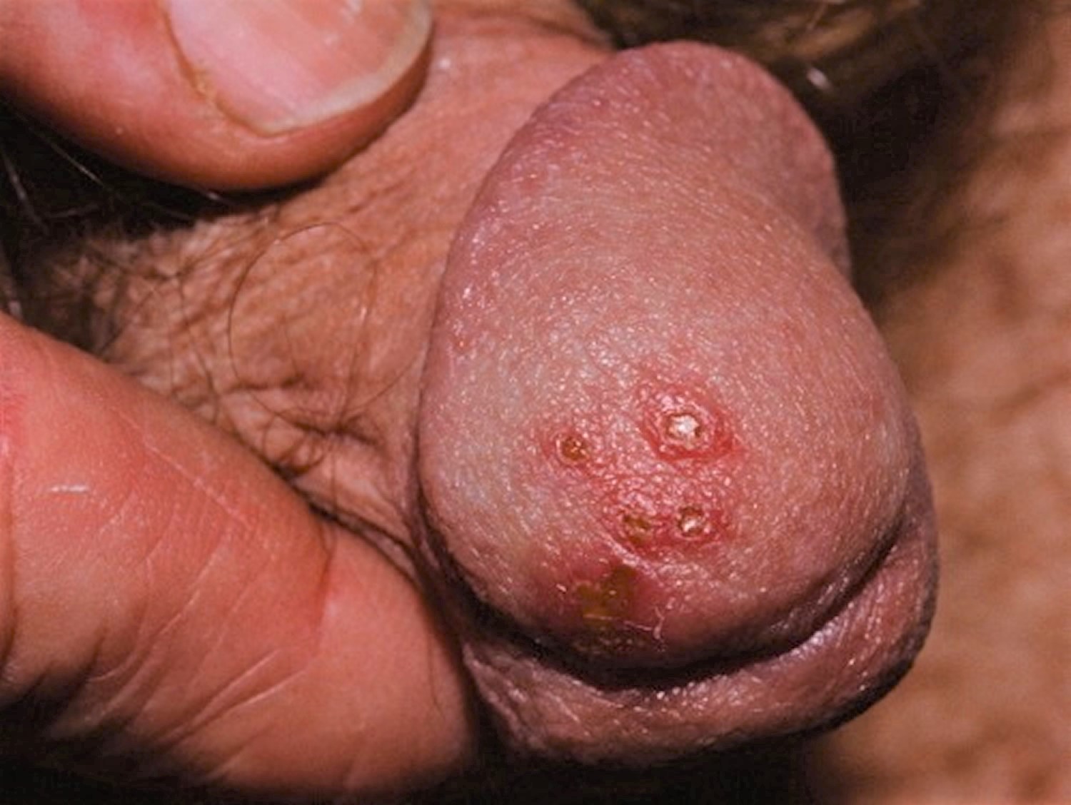 penis herpes