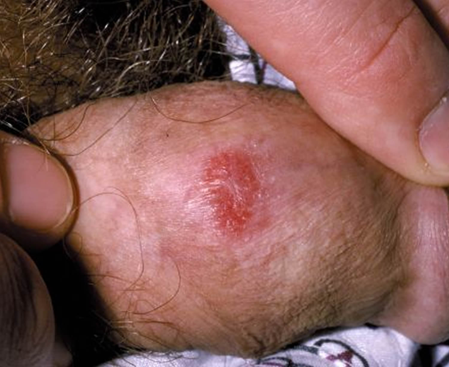 My pimple foreskin on What is. 
