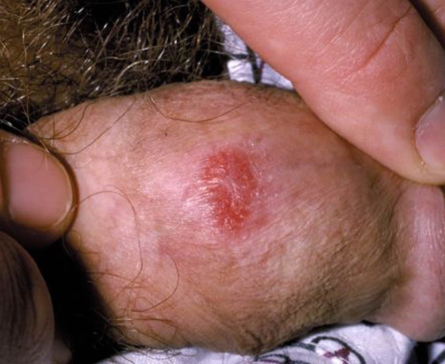 Penile pimples head on Penile Bumps