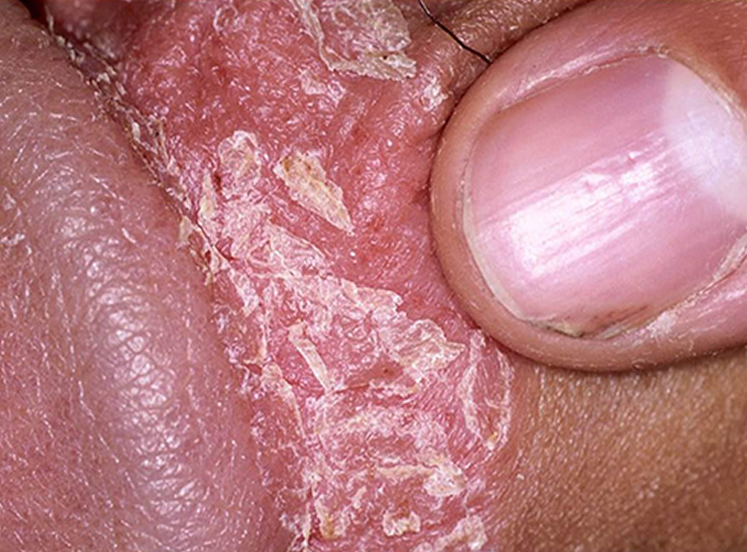 Shaft on pink bumps penile Red Spot