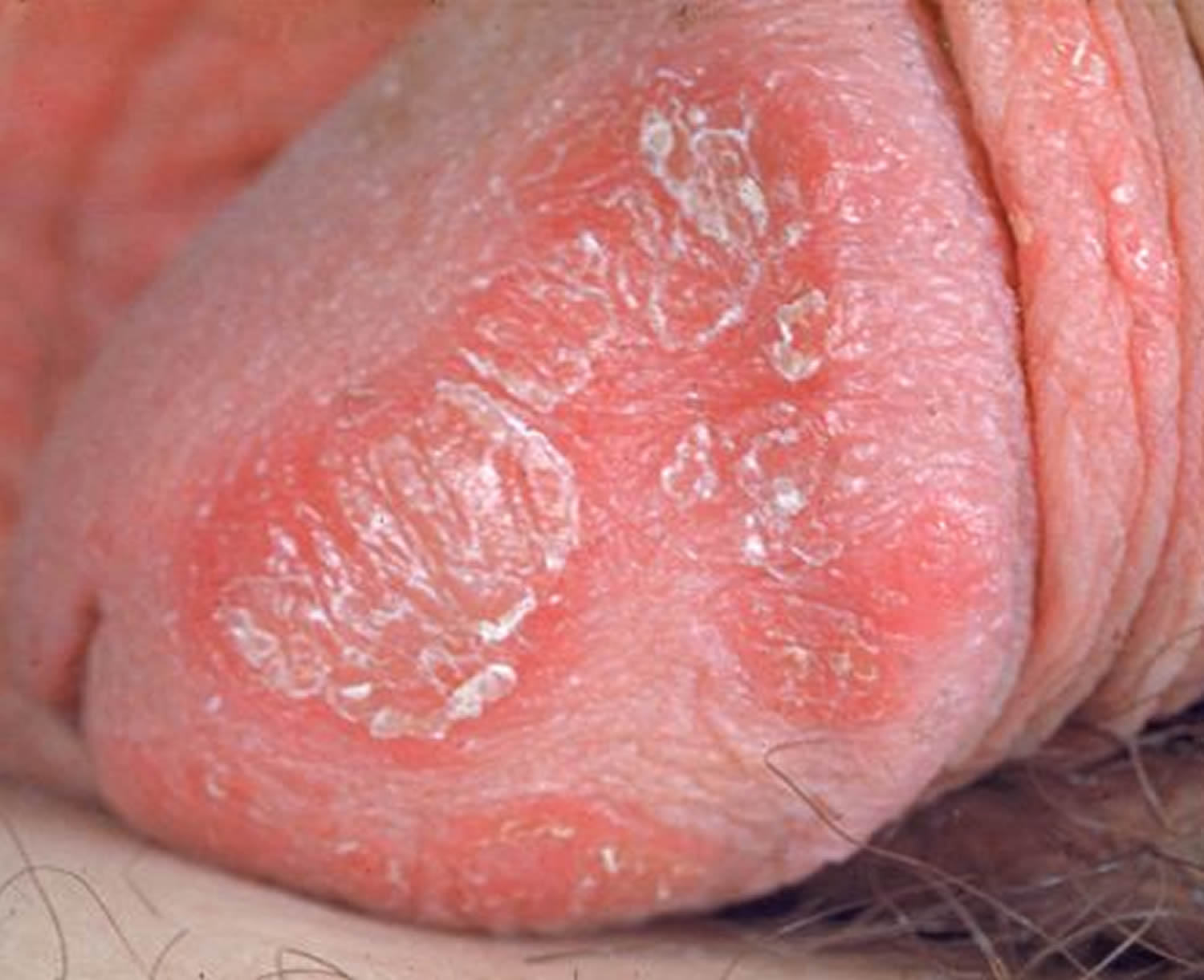 Whiteheads on penile shaft